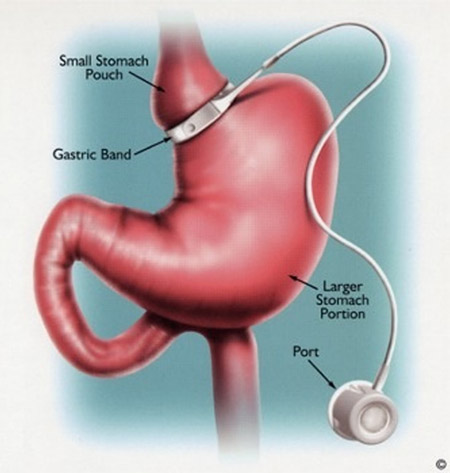 Adjustable gastric banding